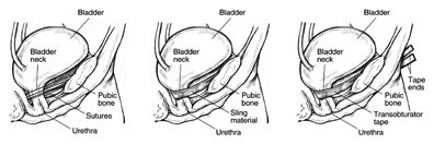 Side view diagrams of three female bladders after different types of continence surgery.  The diagram on the left shows a bladder held in place by sutures that form a supportive web for the bladder.  Labels point to the bladder, bladder neck, pubic bone, sutures, and urethra.  The diagram in the middle shows a bladder held in place by a ribbon-like sling that wraps around the bladder neck.  Labels point to the bladder, bladder neck, pubic bone, sling material, and urethra.  The diagram on the right shows a bladder held in place by a tape material wrapped around the bladder neck with tape ends emerging through incisions in the groin.  Labels point to the bladder, bladder neck, tape ends, pubic bone, transobturator tape, and urethra.